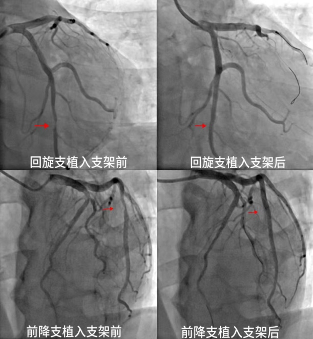 “生命通道”重獲生機(jī)，十堰人醫(yī)成功救治復(fù)雜冠心病危重患者