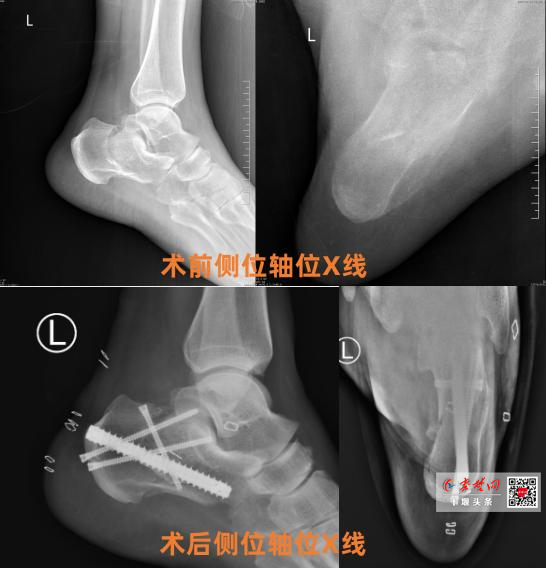 十堰人醫應用“跟骨釘中釘”微創技術助骨折患者快速康復