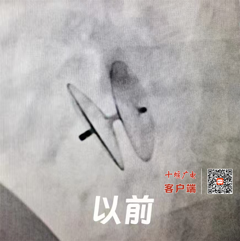 十堰人醫可降解封堵器治療卵圓孔未閉取得成功
